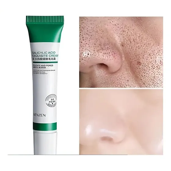 Creme De Ácido Salicílico Para Remoção De Poros De Acne 20g